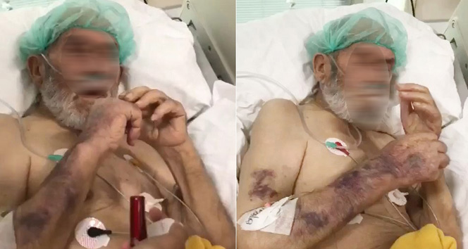 Hastanede skandal görüntü: Yoğun bakımdaki yaşlı hastaya sigara verdiler