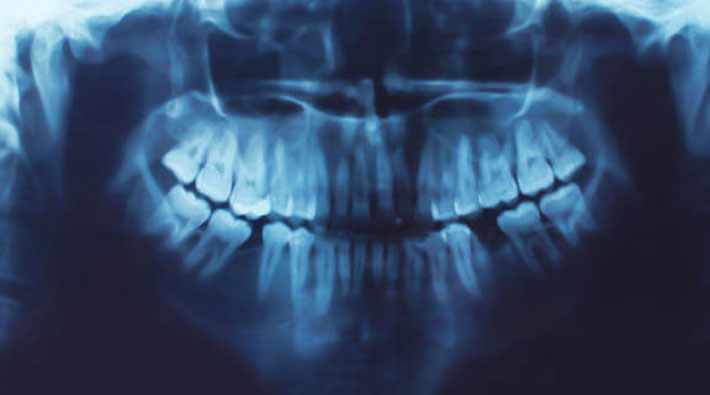 Çürük dişlerin iyileşmesini sağlayan ilaç geliştirildi