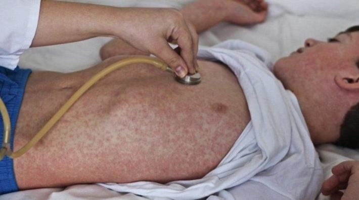 DSÖ: Koronavirüs kısıtlamaları kızamık vakalarını arttırdı