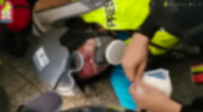 Hong Kong polisinin plastik mermiyle vurduğu gazeteci gözünü kaybetti