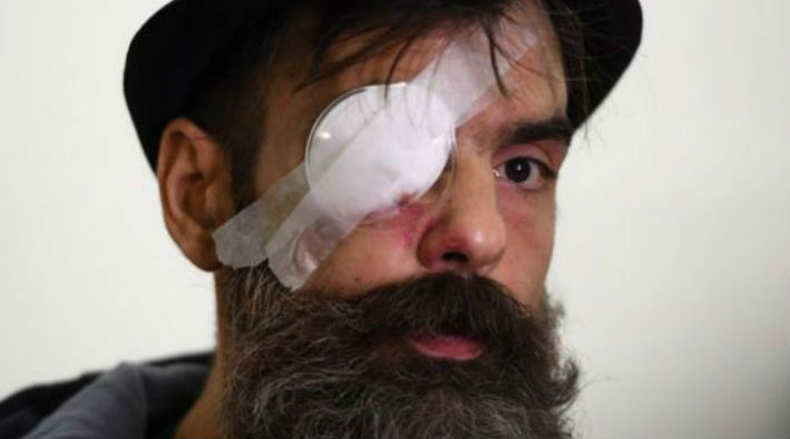 Sarı Yelekliler eyleminin lideri plastik mermiyle vuruldu: Gözünü kaybetti