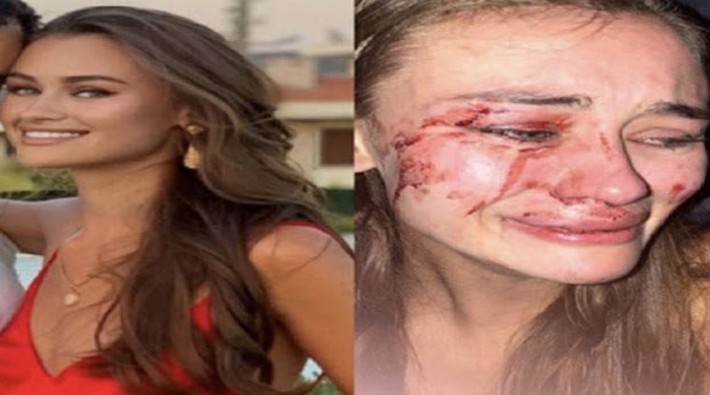 Ukraynalı model Daria Kyryliuk: Çeşme Momo Beach Club güvenliklerinin saldırısına uğradık
